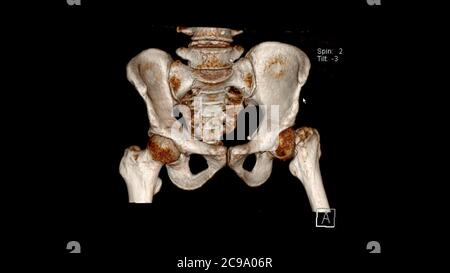 Tomografia computerizzata Volume rendering esame del bacino che mostra una frattura del collo del femore sinistro ( CT VR Pelvis). Rendering 3D Foto Stock