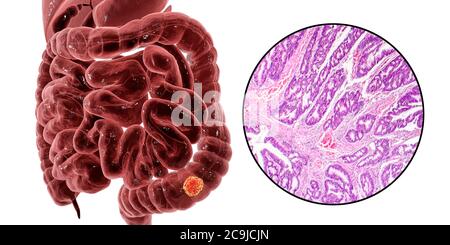 Cancro del colon, illustrazione del computer e micrografia leggera che mostra l'adenocarcinoma del colon. Foto Stock
