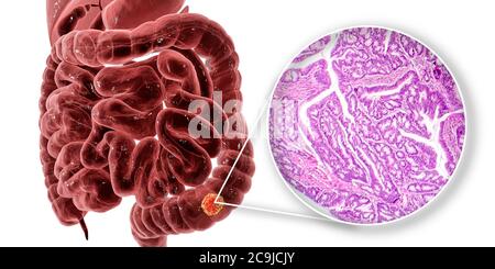 Cancro del colon, illustrazione del computer e micrografia leggera che mostra l'adenocarcinoma del colon. Foto Stock