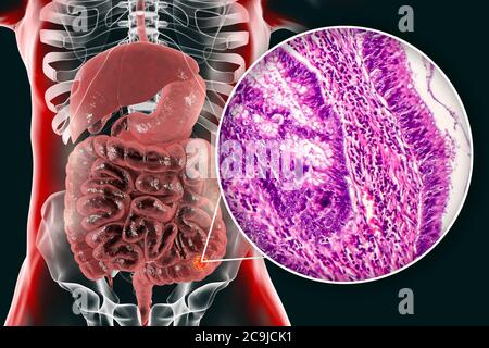 Cancro del colon, illustrazione del computer e micrografia leggera che mostra l'adenocarcinoma del colon. Foto Stock
