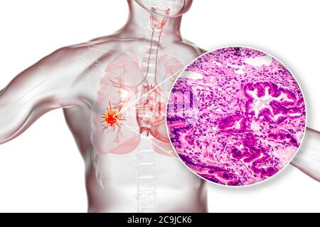 Cancro ai polmoni, illustrazione del computer e micrografia leggera. Micrografia leggera che mostra l'adenocarcinoma polmonare. Foto Stock