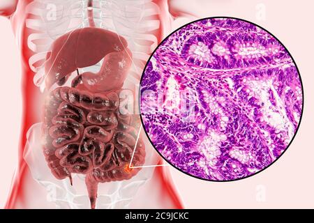 Cancro del colon, illustrazione del computer e micrografia leggera che mostra l'adenocarcinoma del colon. Foto Stock