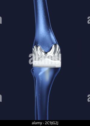Sostituzione ginocchio, illustrazione. Foto Stock