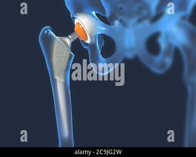 Sostituzione dell'anca, illustrazione. Foto Stock