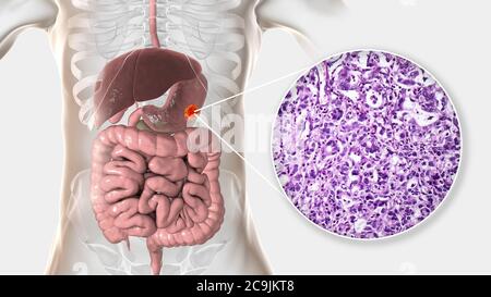 Adenocarcinoma dello stomaco umano, illustrazione del computer e micrografia leggera. Foto Stock