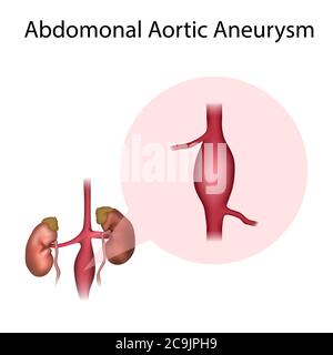 Aneurisma aortico addominale, illustrazione. Un aneurisma è una dilatazione del sangue in un vaso sanguigno. Foto Stock
