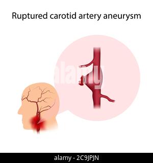 Aneurisma dell'arteria carotide rotto, illustrazione. Un aneurisma è una dilatazione del sangue in un vaso sanguigno. Foto Stock