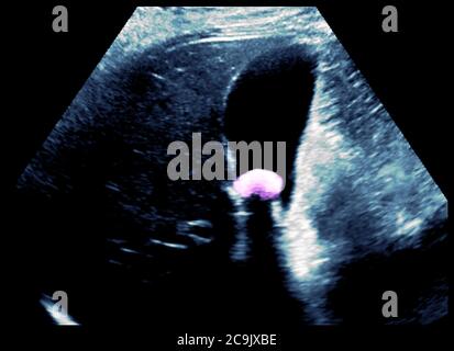 Gallstone. Ecografia colorata della cistifellea di una donna di 33 anni, con un grosso gallone (15 millimetri di diametro) al centro. Il gall Foto Stock