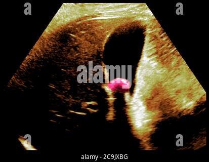 Gallstone. Ecografia colorata della cistifellea di una donna di 33 anni, con un grosso gallone (15 millimetri di diametro) al centro. Il gall Foto Stock