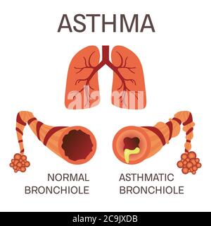 Bronchioli normali e asmatici, illustrazione. Foto Stock