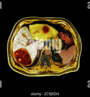 Cancro al fegato. Tomografia assiale computerizzata colorata (CT) scansiona attraverso l'addome di un uomo di 80 anni con cancro del fegato. Il fegato è al centro Foto Stock