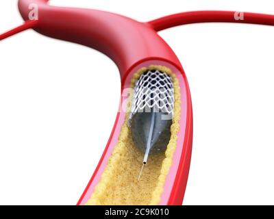 Stent all'interno di un'arteria, illustrazione. Foto Stock