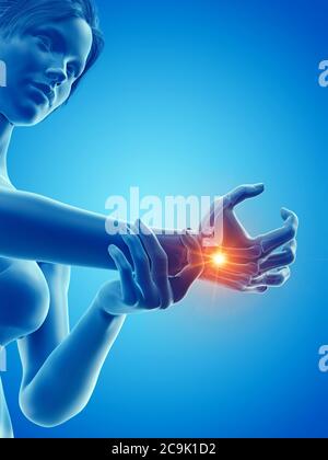 Donna con una mano dolorosa, illustrazione. Foto Stock