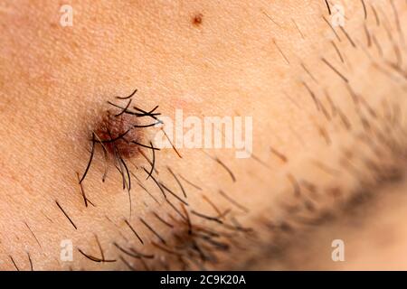 Mole sul viso di un uomo con i capelli del viso che crescono da esso. Foto Stock