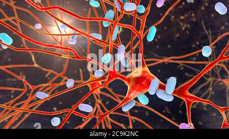 Encefalite batterica. Illustrazione concettuale del computer che mostra i batteri che infettano le cellule cerebrali. Foto Stock