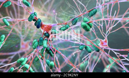 Encefalite batterica. Illustrazione concettuale del computer che mostra i batteri che infettano le cellule cerebrali. Foto Stock