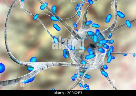 Encefalite batterica. Illustrazione concettuale del computer che mostra i batteri che infettano le cellule cerebrali. Foto Stock