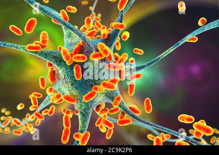 Encefalite batterica. Illustrazione concettuale del computer che mostra i batteri che infettano le cellule cerebrali. Foto Stock