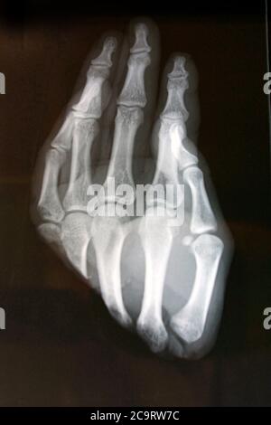 immagine radiografica di una mano umana con cinque dita Foto Stock