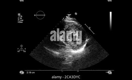 Immagine del cuore in modalità scala di grigi durante l'ecografia transesofagea. Foto Stock