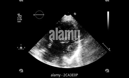 Immagine del cuore in modalità scala di grigi durante l'ecografia transesofagea. Foto Stock