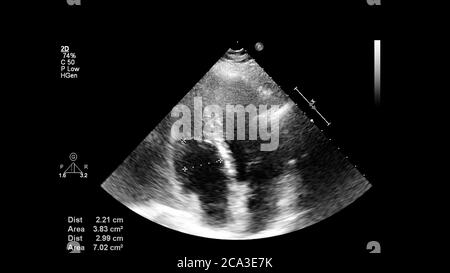 Immagine del cuore in modalità scala di grigi durante l'ecografia transesofagea. Foto Stock