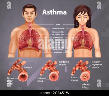 Confronto tra un'illustrazione polmonare sana e un'illustrazione polmonare asmatica Illustrazione Vettoriale