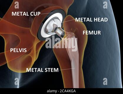 Illustrazione accurata dal punto di vista medico della sostituzione dell'anca. illustrazione 3d. Foto Stock