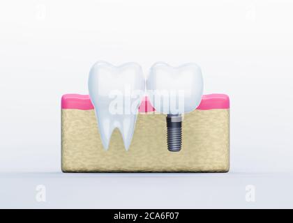 Dente bianco e dente impianto in gengive su sfondo bianco, dente artificiale, rendering 3d Foto Stock