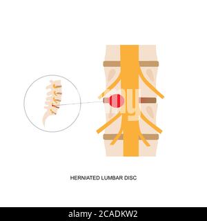 Illustrazione della dimostrazione del disco lombare erniato umano. L'erniazione del disco lombare può causare dolore alla schiena basso e sciatica Illustrazione Vettoriale