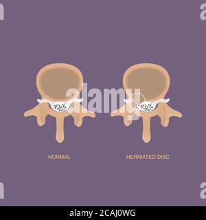 Illustrazione vettoriale dimostrazione della vista assiale del disco lombare erniato. L'erniazione del disco lombare può causare dolore alla schiena basso e sciatica Illustrazione Vettoriale