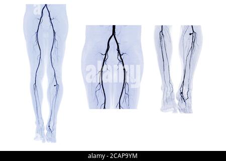 Raccolta dell'arteria femorale CTA eseguita dall'immagine 3D MIP Dell'arteria femorale per la diagnosi arterioso periferico acuto o cronico Malattia e artero femorale Foto Stock