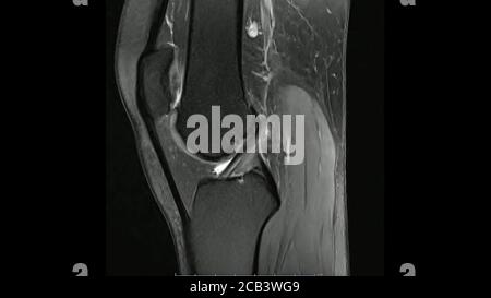 Immagini di risonanza magnetica della densità protonica sagittale dell'articolazione del ginocchio Immagini in modalità cine (articolazione ginocchio RM) mostra l'anatomia del ginocchio Foto Stock