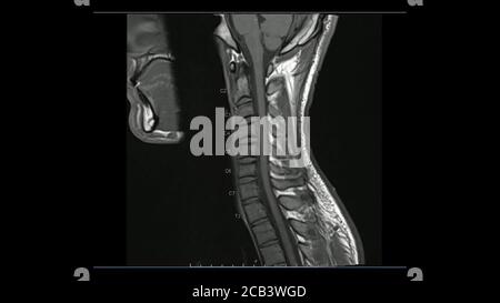 Immagini di risonanza magnetica di immagine T1 pesata sagittale della colonna cervicale (MRI colonna cervicale) che mostrano una lieve malattia del disco. Foto Stock