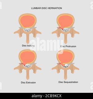 Illustrazione vettoriale dimostrazione della vista assiale del disco lombare erniato. Grado del disco lombare compreso rigonfiamento del disco, protrusione, estrusione, sequestr Illustrazione Vettoriale