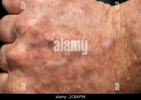 Primo piano di una lesione di cheratosi attinica o di macchie solari sulla pelle danneggiata dal sole della mano di un uomo. Questo può essere trattato con criochirurgia o unguenti Foto Stock