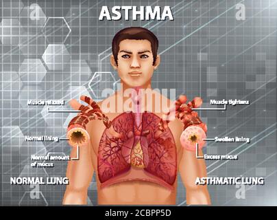 Confronto tra un'illustrazione polmonare sana e un'illustrazione polmonare asmatica Illustrazione Vettoriale