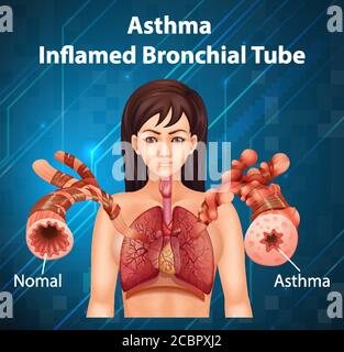 Anatomia umana Asma inflamed bronchiale diagramma del tubo Illustrazione Vettoriale