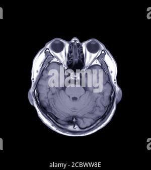 MRI della vista T1 assiale cerebrale per rilevare una varietà di condizioni del cervello come cisti, tumori, sanguinamento isolato su sfondo nero, bleedina Foto Stock