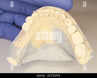 Dental mold dentist clay teeth plate ceramic colored cast model showing  tooth decay and gums of patient in dental clinic surgery for diagnosis and  treatment held in sterile glove hand of dentist