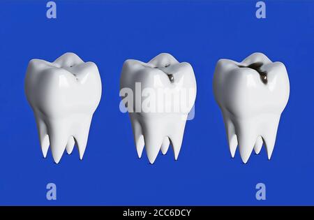 Tre denti in fila, tre stadi di decadimento dei denti, carie, denti irritati, rendering 3d Foto Stock