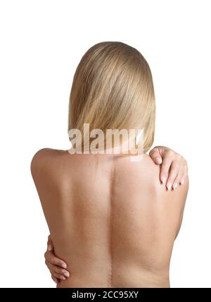 Giovane donna con cicatrici da chirurgia spinale. Foto Stock