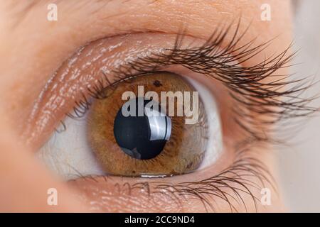 Macro occhio foto. Cheratoconus 2 gradi - malattia oculare, assottigliamento della cornea sotto forma di cono. La plastica cornea. Foto Stock