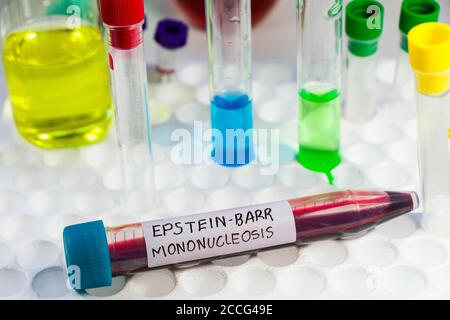 Mononucleosi e campione di analisi del sangue del virus Epstein-barr in laboratorio su fondo bianco Foto Stock