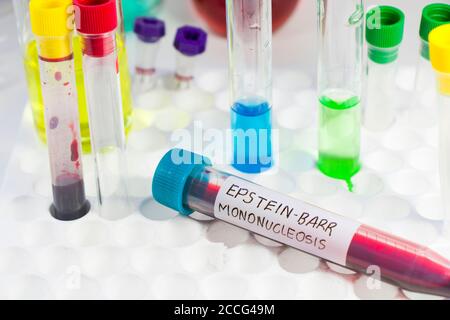 Mononucleosi e campione di analisi del sangue del virus Epstein-barr in laboratorio su fondo bianco Foto Stock