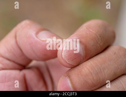 Unghie che hanno malattia fungine sulla mano e piede Foto Stock