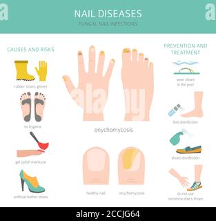 Malattie delle unghie. Onicomicosi, infezioni fungine delle unghie cause, trattamento icona set. Progettazione infografica medica. Illustrazione vettoriale Illustrazione Vettoriale