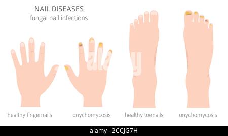 Malattie delle unghie. Onicomicosi, infezioni fungine delle unghie cause, trattamento icona set. Progettazione infografica medica. Illustrazione vettoriale Illustrazione Vettoriale