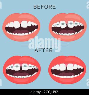 Bocca aperta, denti con correzione del rinforzo prima e dopo l'illustrazione vettoriale. Illustrazione Vettoriale