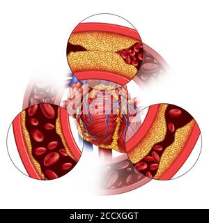 Malattia dell'arteria cardiaca e concetto medico coronarico come formazione graduale della placca con conseguente ostruzione delle arterie e aterosclerosi come anatomia umana. Foto Stock